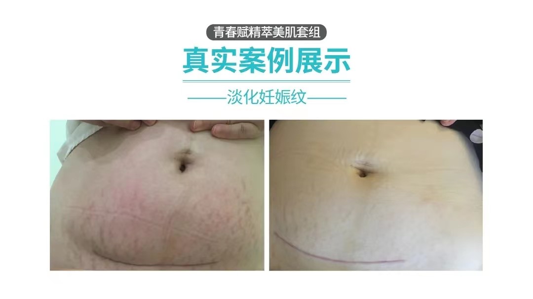 淡化妊娠纹案例 淡化妊娠纹案例